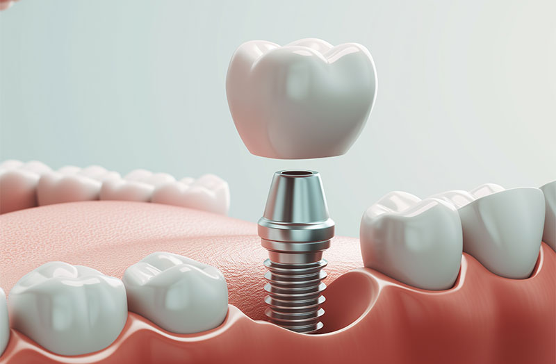 Dental Implants at Ramani Dentistry in South Lyon, MI