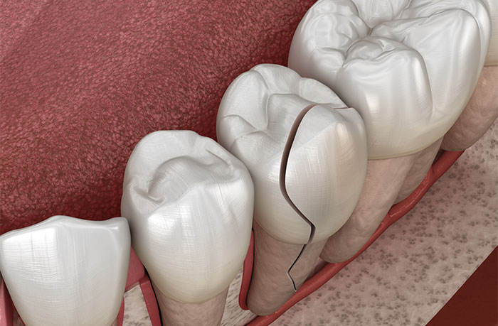 Traumatic Dental Injuries at Ramani Dentistry in South Lyon, MI